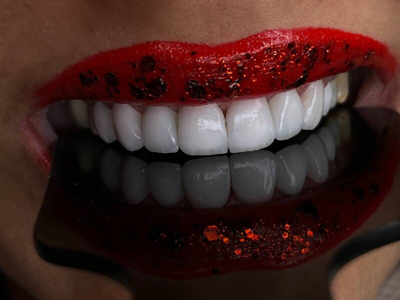 نمونه لمینت دندان کلینیک دندانپزشکی میترا