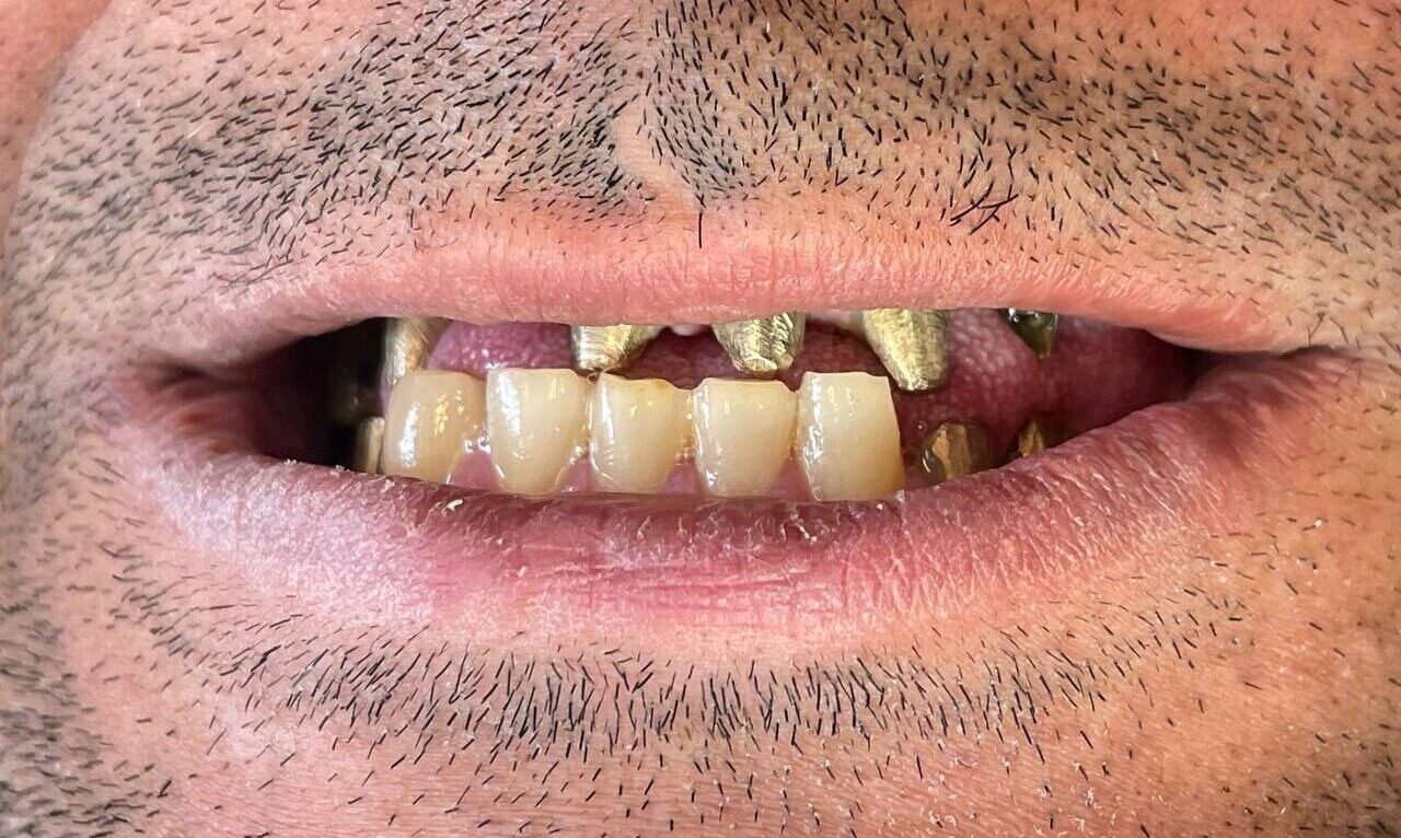 نمونه ایمپلنت قبل