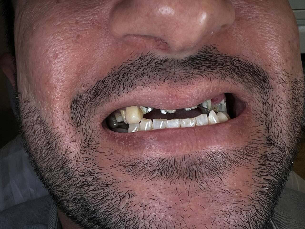 لمینت دندان قبل