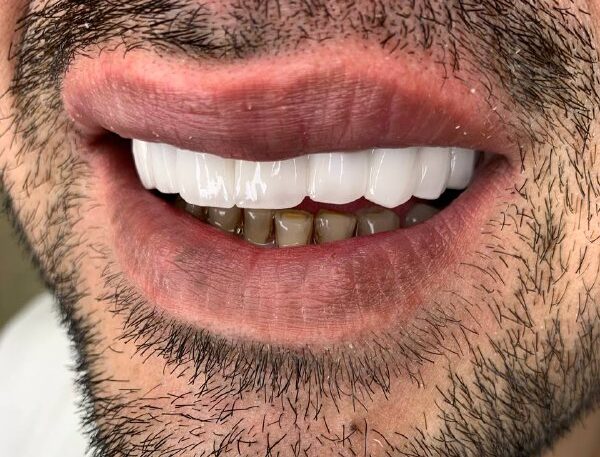 نمونه ایمپلنت بعد